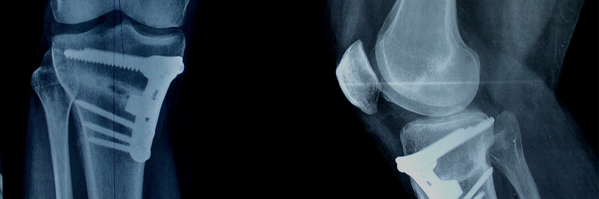 osteotomie genunchi