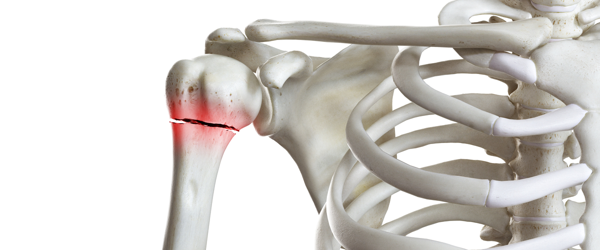 fractura humerus proximal