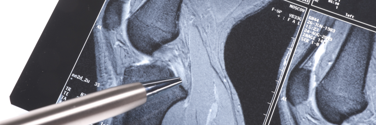 /uploads/assets-v1/f2e805d6-7c16-4dfa-82da-a01967833535/reconstructia-ligamentului-incrucisat-posterior-3.jpg