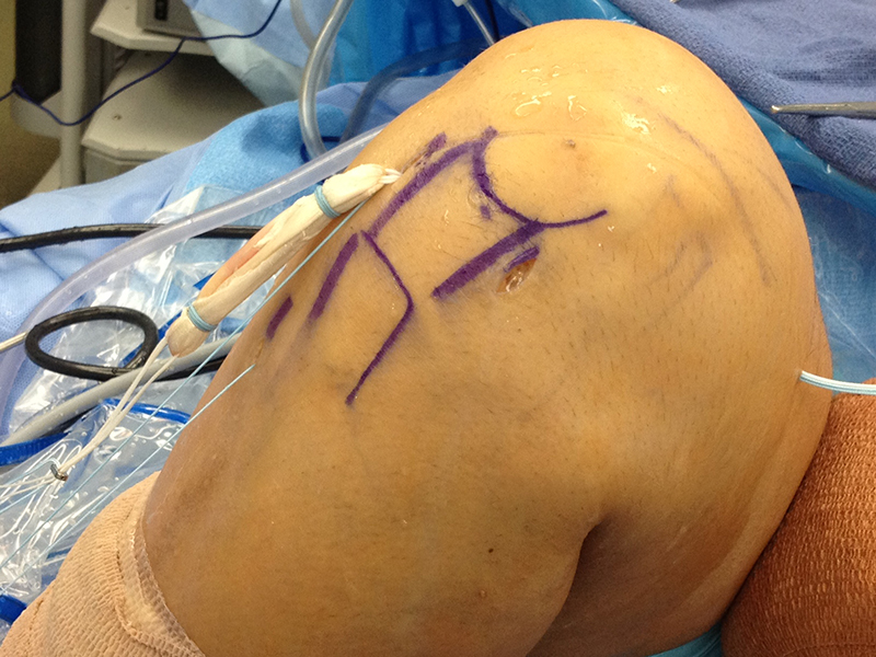 ligamentoplastie LIA all inside