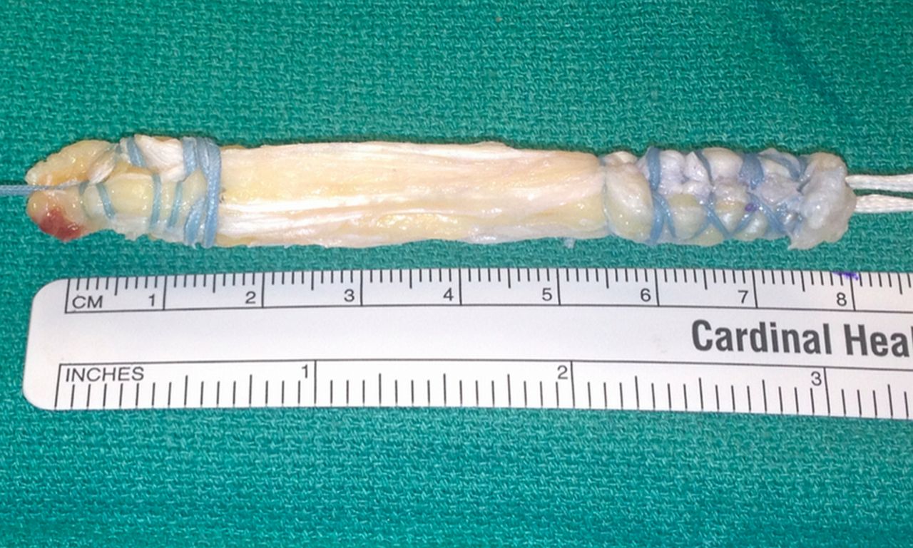 grefa tendon cvadriceps