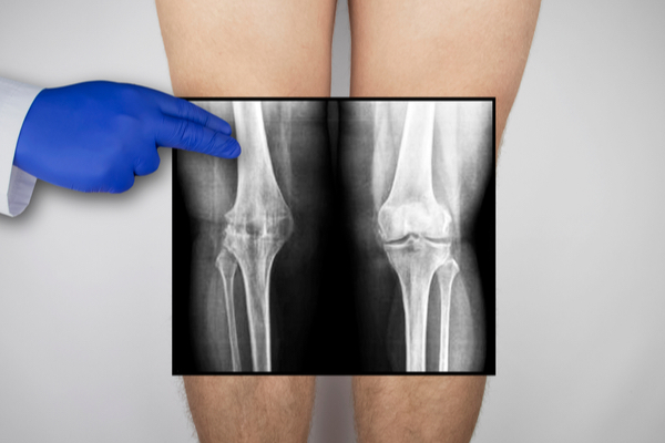 strângerea genunchiului în timpul tratamentului de extensie